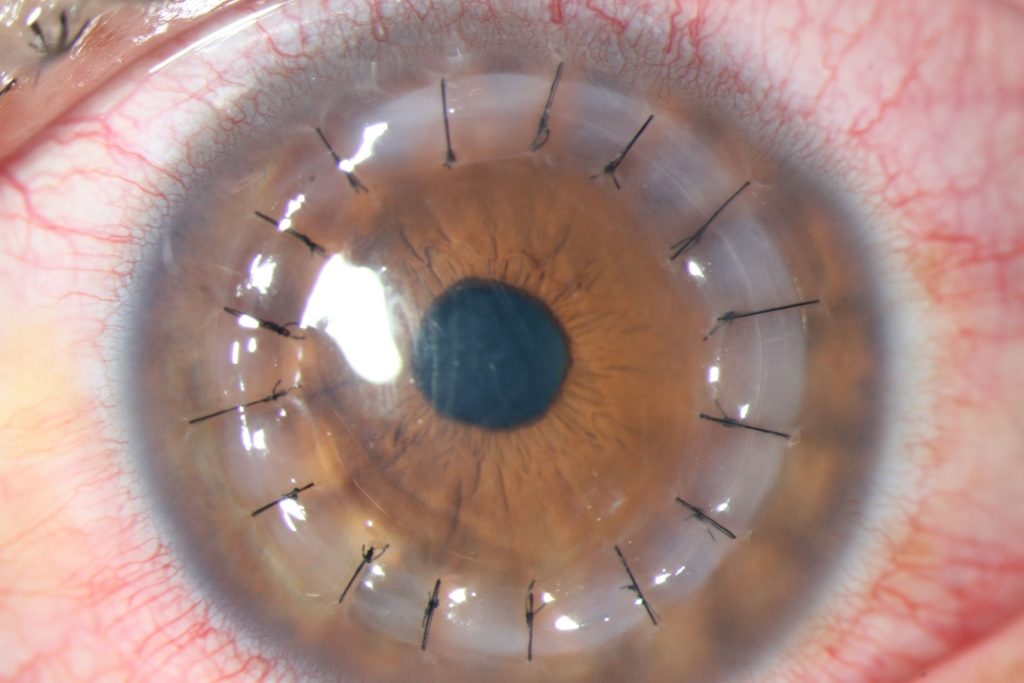 TRASPALNTE-DE-CORNEA-1024x683-1
