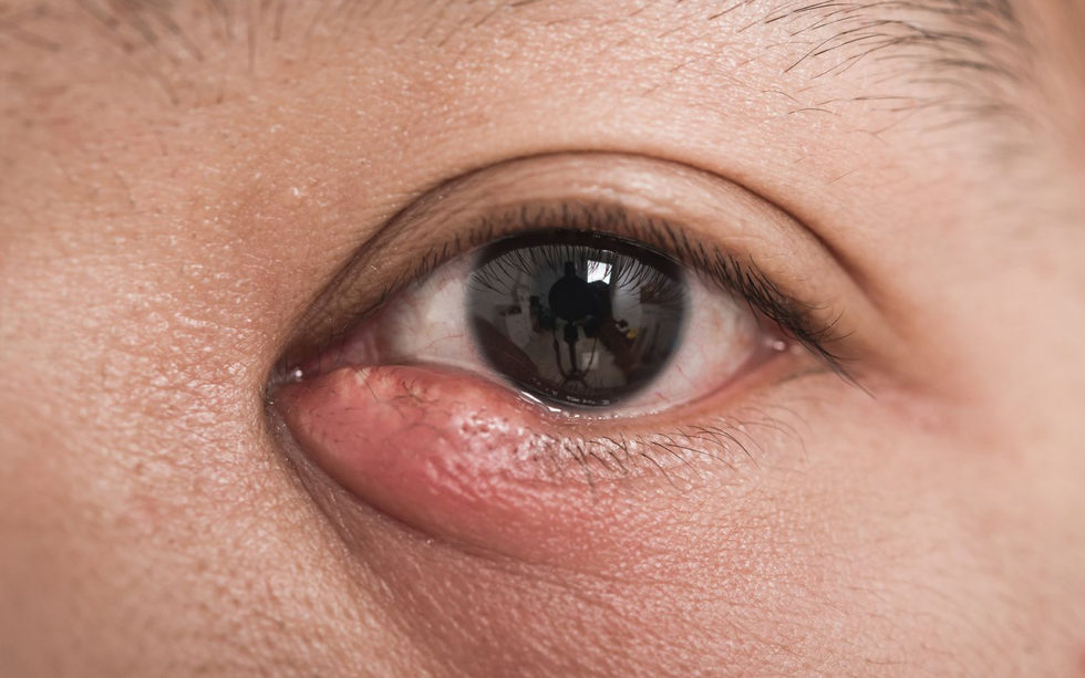 CHALAZION CLÍNICA VISTA